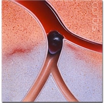 Артериальные тромбозы и эмболии